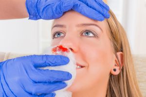Broken Nose NHS - Medical Experts
